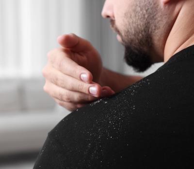 Dermatitis na lasišču: znaki, vzroki in zdravljenje (kako ga ločiš od prhljaja)